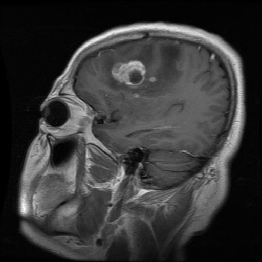 Glioma