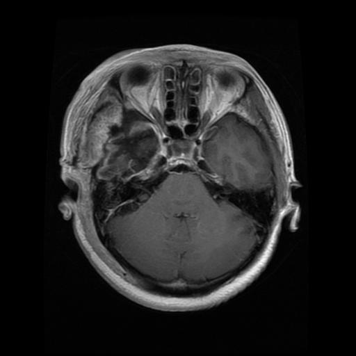 Glioma