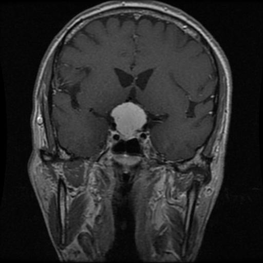 Meningioma